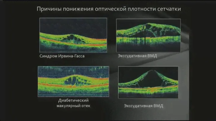 Оптическая когерентная томография (ОКТ)