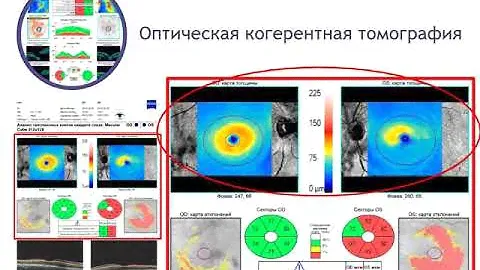 ОКТ в диагностике глаукомы